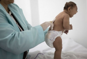 Zika birth defect may only become clear months after birth 